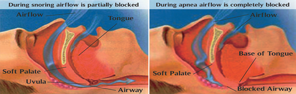 Sleep Apnea