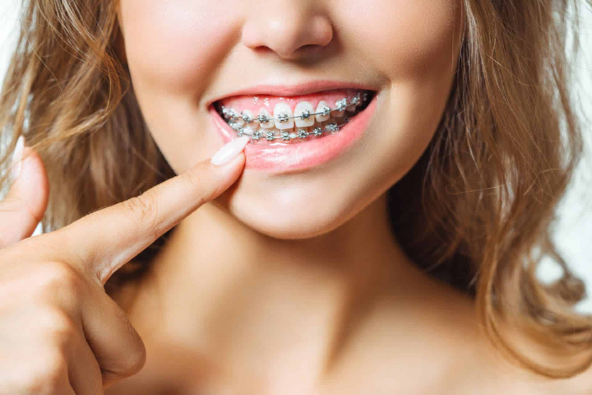 Holiday Care for Braces and Invisalign in Downey CA Brace Connection