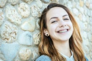 Can You Get Braces Without Recommended Extractions?
Brace Connection in Downey, CA